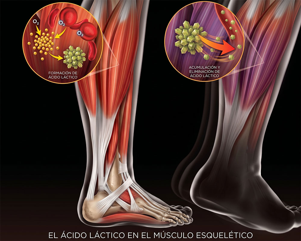 Ilustración anatómica de la pierna humana con diagramas insertados que explican el metabolismo del ácido láctico en el músculo esquelético. El diagrama de la izquierda detalla la 'FORMACIÓN DE ÁCIDO LÁCTICO' a partir de glucosa y oxígeno en un músculo sano, y el de la derecha muestra la 'ACUMULACIÓN Y ELIMINACIÓN DE ÁCIDO LÁCTICO' en un músculo fatigado.
